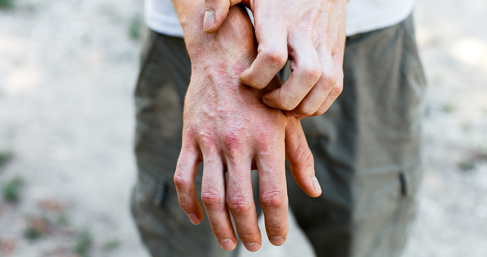 Das Foto zeigt ein Person mit einer allergischen Hautreaktion an der Hand